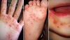 TÌNH HÌNH BỆNH TAY CHÂN MIỆNG TẠI THÀNH PHỐ BẢO LỘC