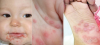 BỆNH TAY CHÂN MIỆNG: MỘT SỐ THÔNG TIN CẦN LƯU Ý
