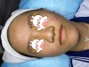 Hình ảnh mụn trứng cá